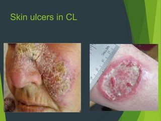 Skin ulcers in CL
 