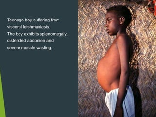Teenage boy suffering from
visceral leishmaniasis.
The boy exhibits splenomegaly,
distended abdomen and
severe muscle wasting.
 