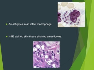  Amastigotes in an intact macrophage.
 H&E stained skin tissue showing amastigotes.
 