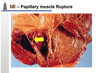 Pathology of Myocardial Infarction | PPT