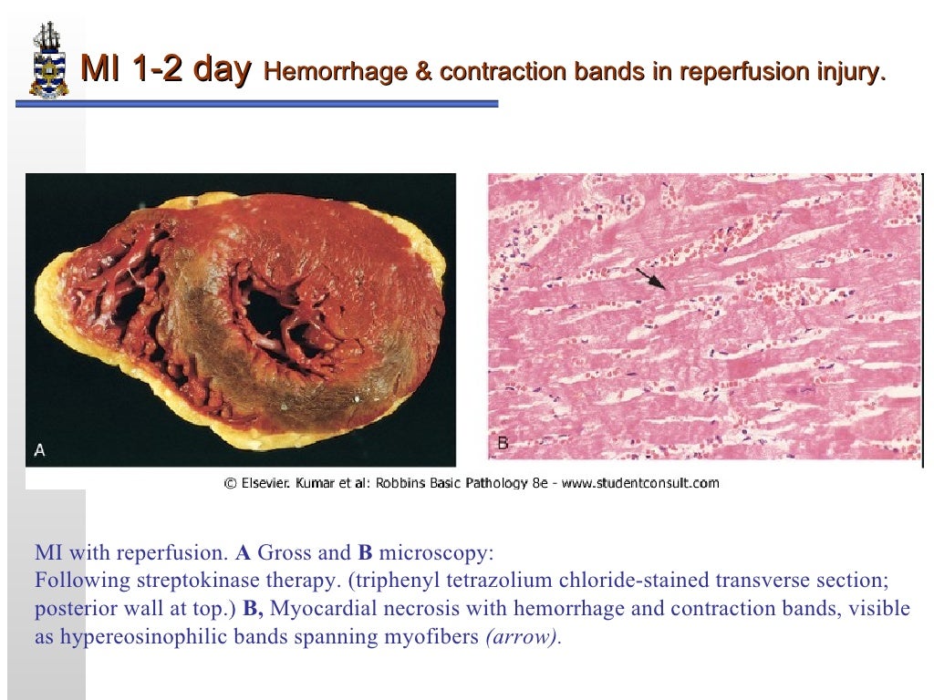 Pathology of Myocardial Infarction