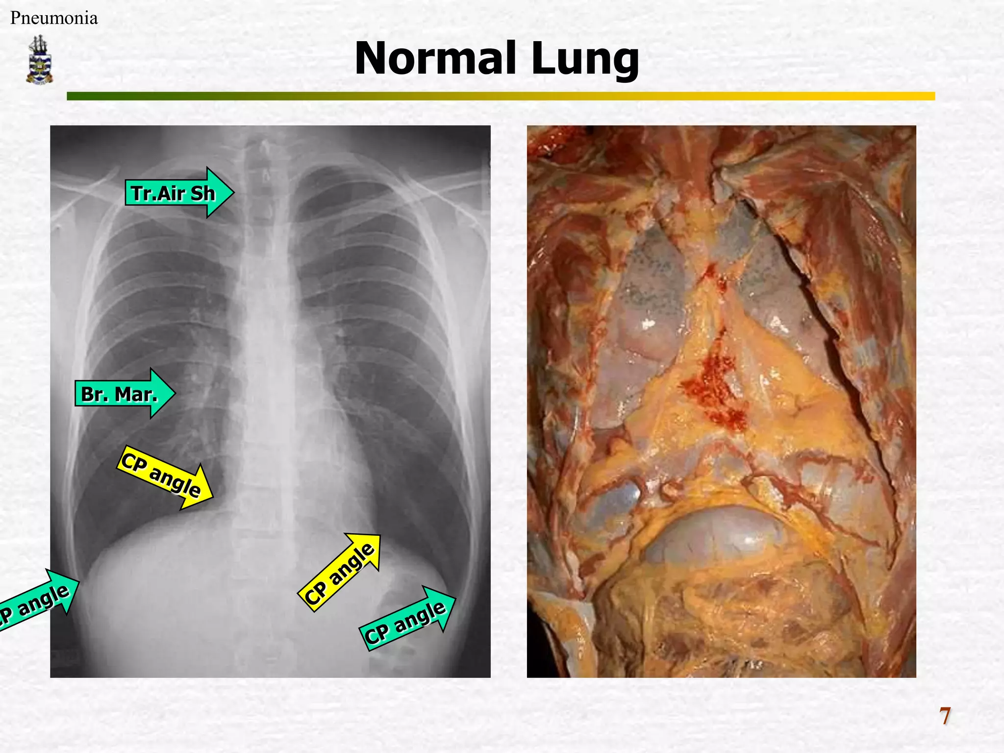 Pneumonia
Normal Lung
Tr.Air Sh
Br. Mar.
7