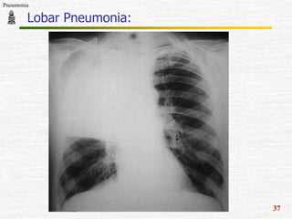 pathology-of-pneumonia-pptx