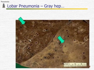 Lobar Pneumonia Gross