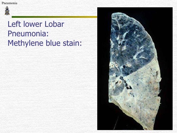 Featured image of post Lobar Pneumonia Gross Specimen