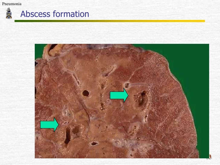 pathology of pneumonia
