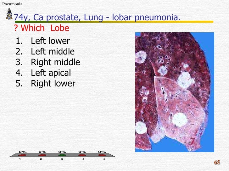 pathology of pneumonia