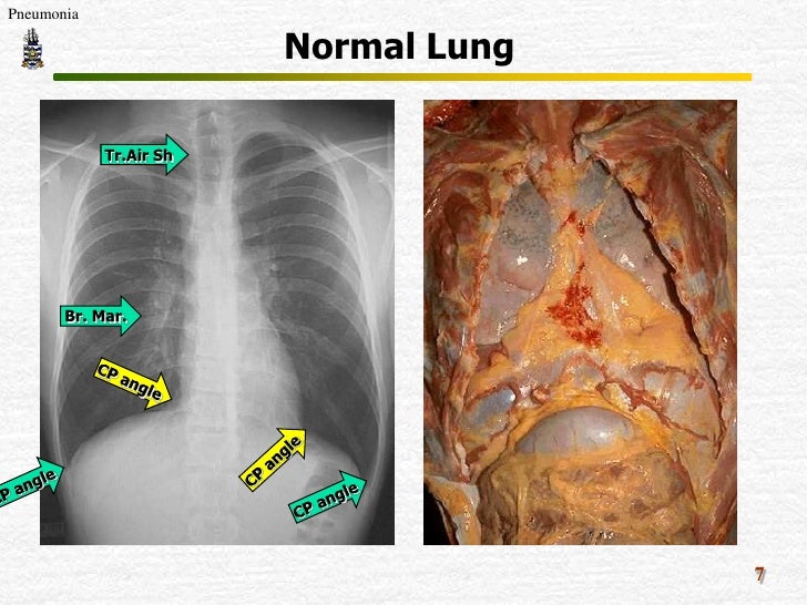 Pathology of Pneumonia