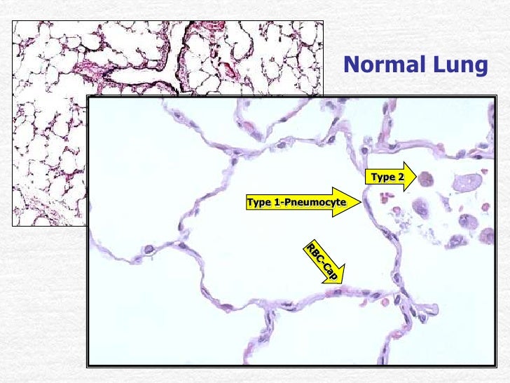 Normal Lung Tissue Slide Doctor Answers