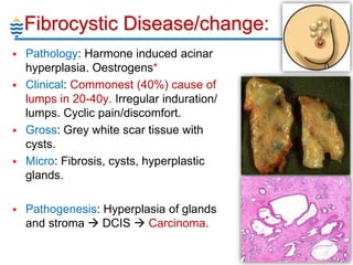 Induration Cyst Breast Pathology Lecture - 2013 | PPTX