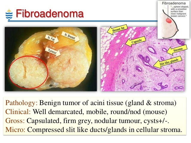 Fibroadenoma Breast Natural Treatment Fibroadenoma Breast Natural Treatment