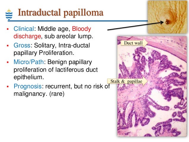 Pathology Outlines - Squamous papilloma
