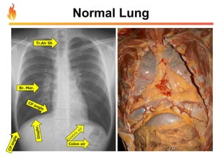 Normal Lung 
Tr.Air Sh 
Br. Mar. 
Colon air 
 