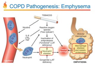 COPD Pathogenesis: Emphysema 
 