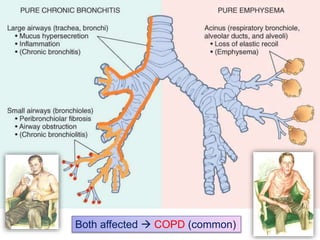 Both affected  COPD (common) 
 
