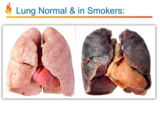 Lung Normal & in Smokers: 
 