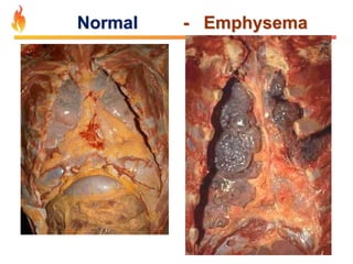 Normal - Emphysema 
 