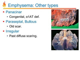 Emphysema: Other types 
 Panacinar 
• Congenital, α1AT def. 
 Paraseptal, Bullous 
• Old scar. 
 Irregular 
• Past diffuse scaring. 
 
