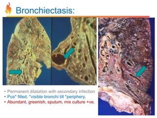 Bronchiectasis: 
• Permanent dilatation with secondary infection 
• Pus* filled, *visible bronchi till *periphery. 
• Abundant, greenish, sputum, mix culture +ve. 
 