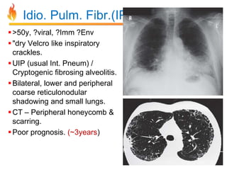 Idio. Pulm. Fibr.(IPF) 
 >50y, ?viral, ?Imm ?Env 
 "dry Velcro like inspiratory 
crackles. 
 UIP (usual Int. Pneum) / 
Cryptogenic fibrosing alveolitis. 
 Bilateral, lower and peripheral 
coarse reticulonodular 
shadowing and small lungs. 
CT – Peripheral honeycomb & 
scarring. 
Poor prognosis. (~3years) 
 