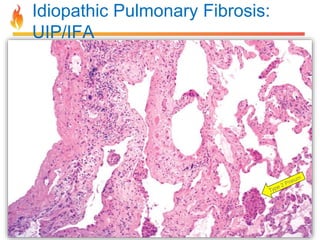 Idiopathic Pulmonary Fibrosis: 
UIP/IFA 
 