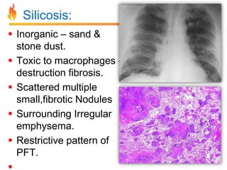 Silicosis: 
 Inorganic – sand & 
stone dust. 
 Toxic to macrophages – 
destruction fibrosis. 
 Scattered multiple 
small,fibrotic Nodules 
 Surrounding Irregular 
emphysema. 
 Restrictive pattern of 
PFT. 
 
 