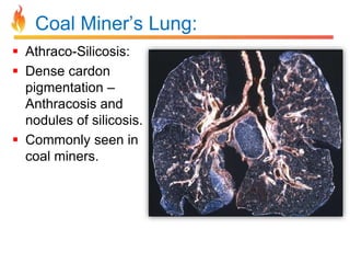 Coal Miner’s Lung: 
 Athraco-Silicosis: 
 Dense cardon 
pigmentation – 
Anthracosis and 
nodules of silicosis. 
 Commonly seen in 
coal miners. 
 