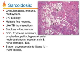 Sarcoidosis: 
 Granulomatous, immune, 
multisystem, 
 ??? Etiology. 
 Multiple fine nodules. 
 Like TB (no caseation). 
 Smokers – Uncommon 
 SOB, Erythema nodosum, 
lymphadenopathy, hypercalcemia, 
nephrocalcinosis, occular, skin & 
nerve damage.. Etc. 
 Stage I asymptomatic to Stage IV – 
Pulm fibrosis. 
 