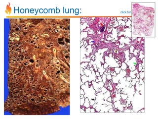 Honeycomb lung: click for online link 
 