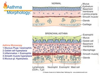 Asthma 
Morphology: 
Asthma Microscopy 
1.Mucous Plugs +eosinophils 
2.Goblet cell hyperplasia 
3.Inflammation + Eosinophils 
4.Smooth muscle hyperplasia 
5.Mucous gl. Hyperplasia. 
 