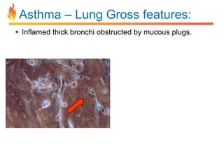 Asthma – Lung Gross features: 
 Inflamed thick bronchi obstructed by mucous plugs. 
 