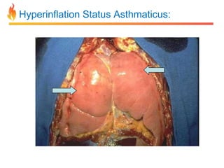 Hyperinflation Status Asthmaticus: 
 