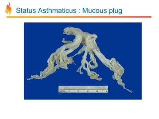 Status Asthmaticus : Mucous plug 
 