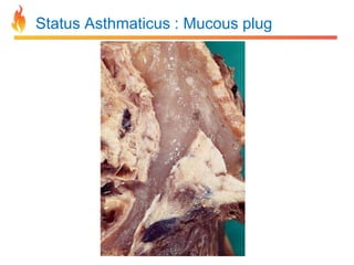 Status Asthmaticus : Mucous plug 
 