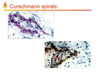 Curschmann spirals: 
 