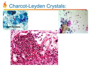 Charcot-Leyden Crystals: 
 