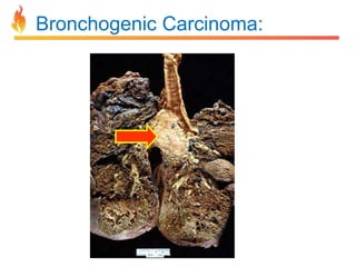 Bronchogenic Carcinoma: 
 