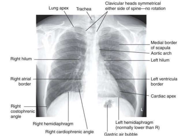 Pathology of COPD
