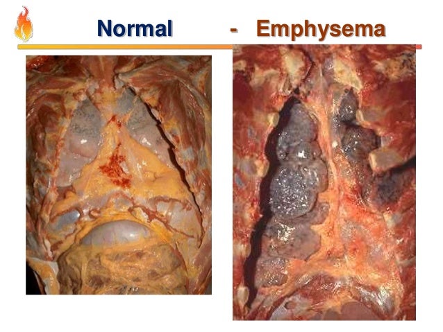 Pathology of COPD