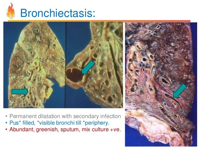 Pathology of COPD