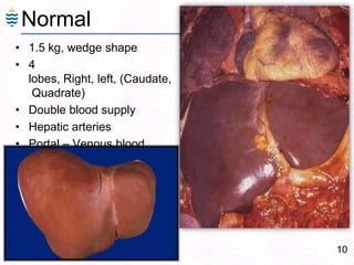 10
• 1.5 kg, wedge shape
• 4
lobes, Right, left, (Caudate,
Quadrate)
• Double blood supply
• Hepatic arteries
• Portal – Venous blood
Normal
 