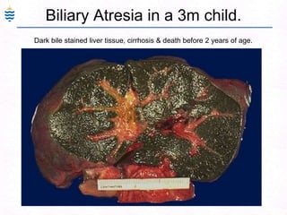 Biliary Atresia in a 3m child.
Dark bile stained liver tissue, cirrhosis & death before 2 years of age.
 