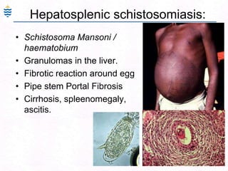 103
Hepatosplenic schistosomiasis:
• Schistosoma Mansoni /
haematobium
• Granulomas in the liver.
• Fibrotic reaction around egg
• Pipe stem Portal Fibrosis
• Cirrhosis, spleenomegaly,
ascitis.
 