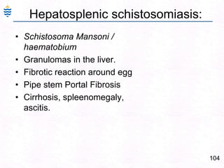 104
Hepatosplenic schistosomiasis:
• Schistosoma Mansoni /
haematobium
• Granulomas in the liver.
• Fibrotic reaction around egg
• Pipe stem Portal Fibrosis
• Cirrhosis, spleenomegaly,
ascitis.
 