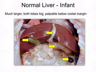 Normal Liver - Infant
Much larger, both lobes big, palpable below costal margin
 