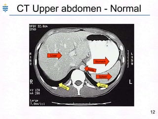 12
CT Upper abdomen - Normal
Liver
Stomach
Spleen
 