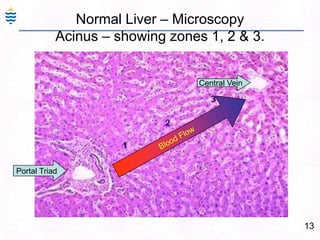 13
Normal Liver – Microscopy
Acinus – showing zones 1, 2 & 3.
Portal Triad
Central Vein
 