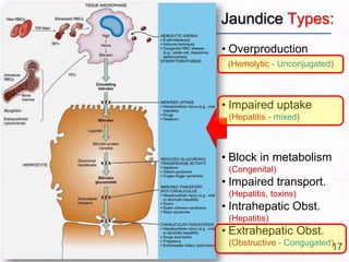 17
• Overproduction
(Hemolytic - Unconjugated)
• Impaired uptake
(Hepatitis - mixed)
• Block in metabolism
(Congenital)
• Impaired transport.
(Hepatitis, toxins)
• Intrahepatic Obst.
(Hepatitis)
• Extrahepatic Obst.
(Obstructive - Congugated)
Jaundice Types:
 