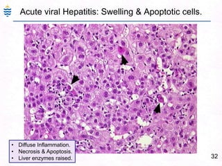 32
Acute viral Hepatitis: Swelling & Apoptotic cells.
• Diffuse Inflammation.
• Necrosis & Apoptosis.
• Liver enzymes raised.
 