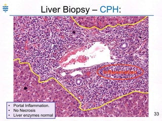 33
Liver Biopsy – CPH:
Inflammation
• Portal Inflammation.
• No Necrosis
• Liver enzymes normal
 